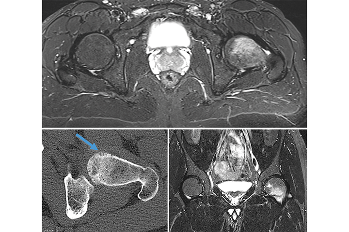 Ostéome ostéoïde intra-articulaire de la tête fémorale