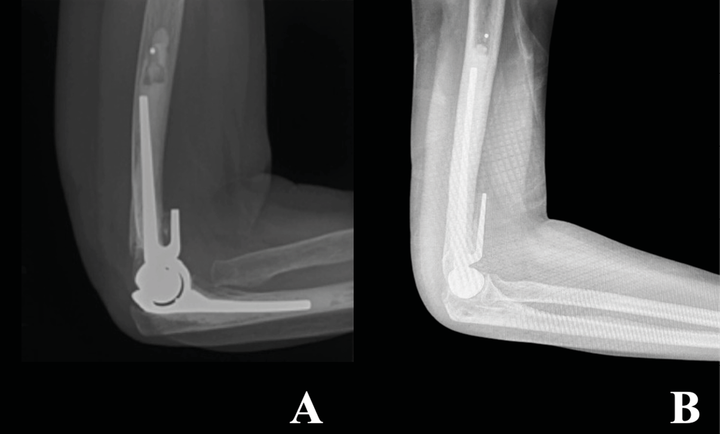Fractures distales de l'humérus chez l'adulte