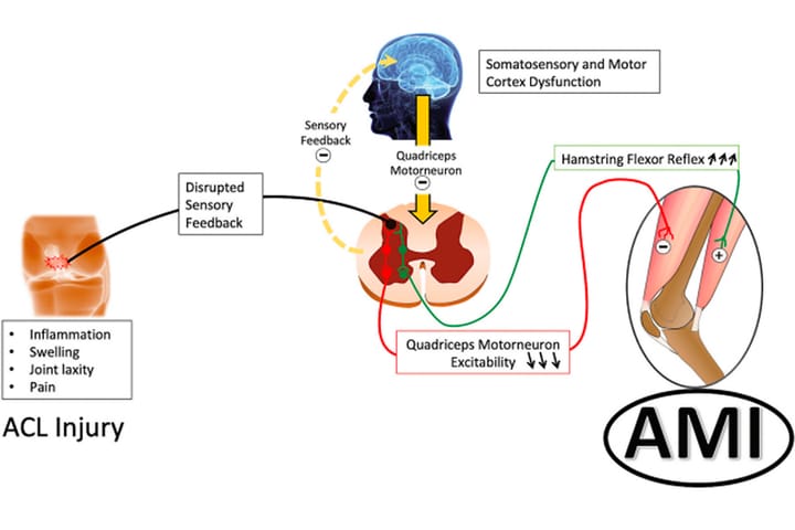 Inhibition musculaire arthrogène et arthroplastie du genou : implications pour la prise en charge rééducative